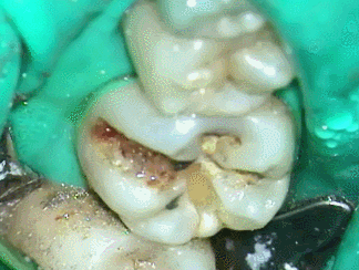 左下6金属除去 2014.06.27　3.gif